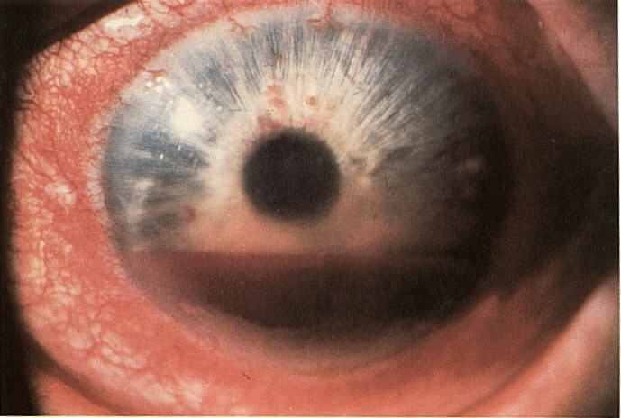 hyphema.JPG